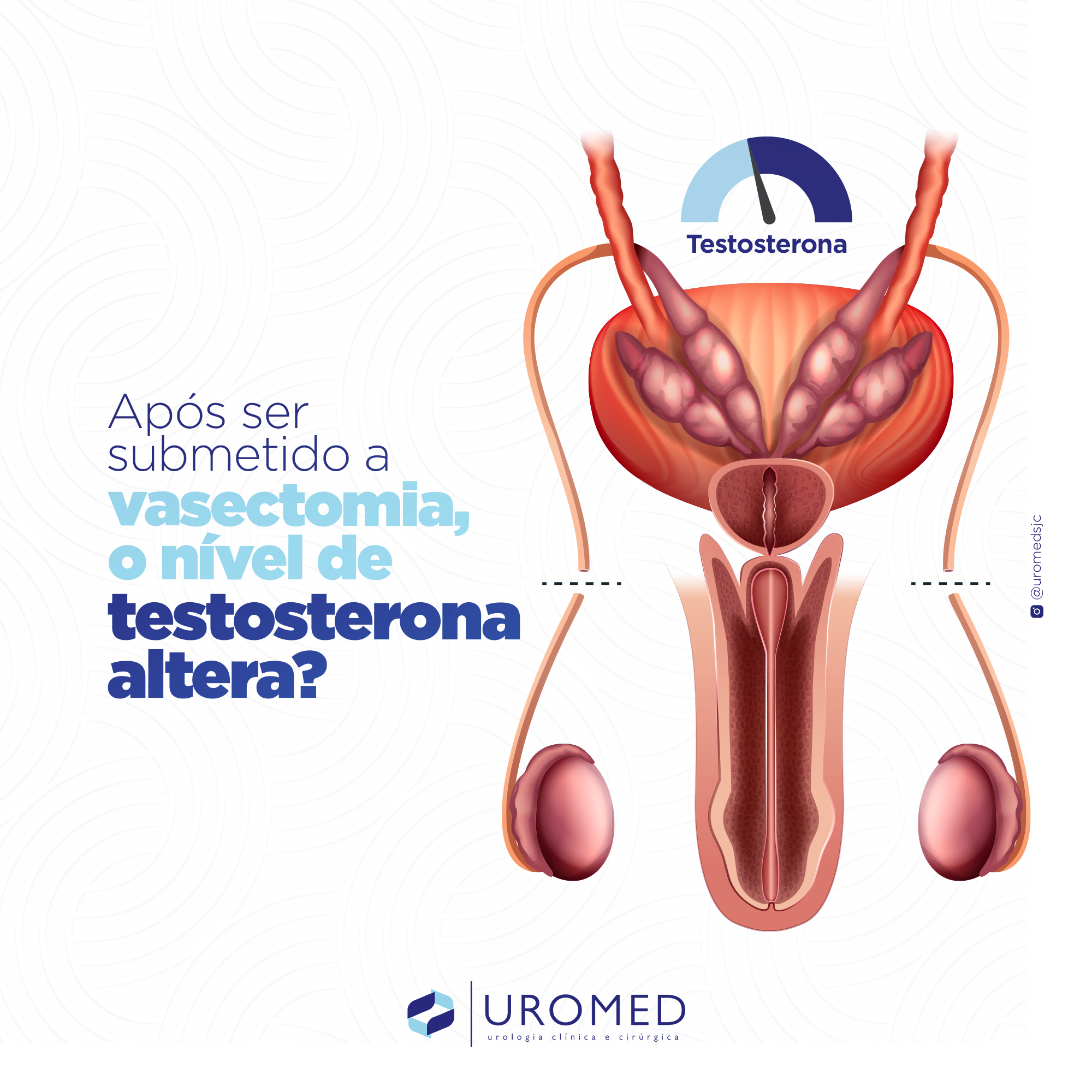 A Vasectomia Altera A Testosterona Uromed